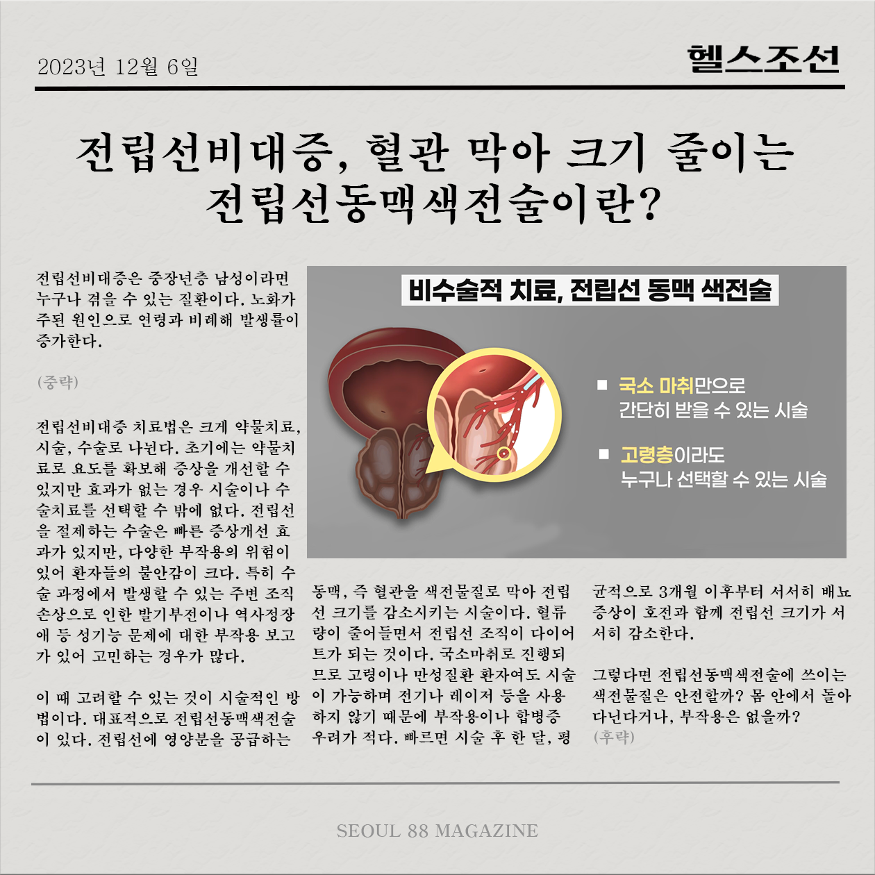 [헬스조선 기사] 전립선비대증, 혈관 막아 크기 줄이는 전립선동맥색전술이란?